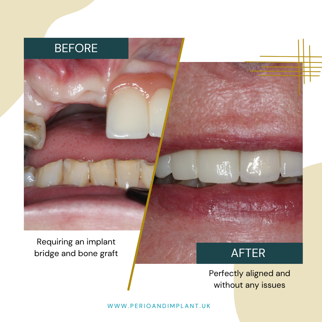 Before and after of a dental procedure