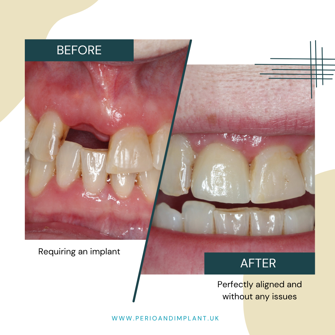 Before and after of a dental procedure