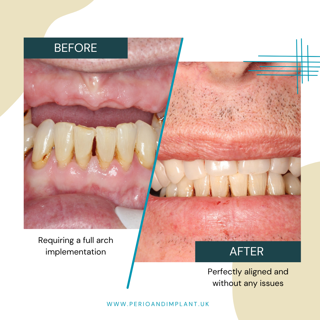 Before and after of a dental procedure
