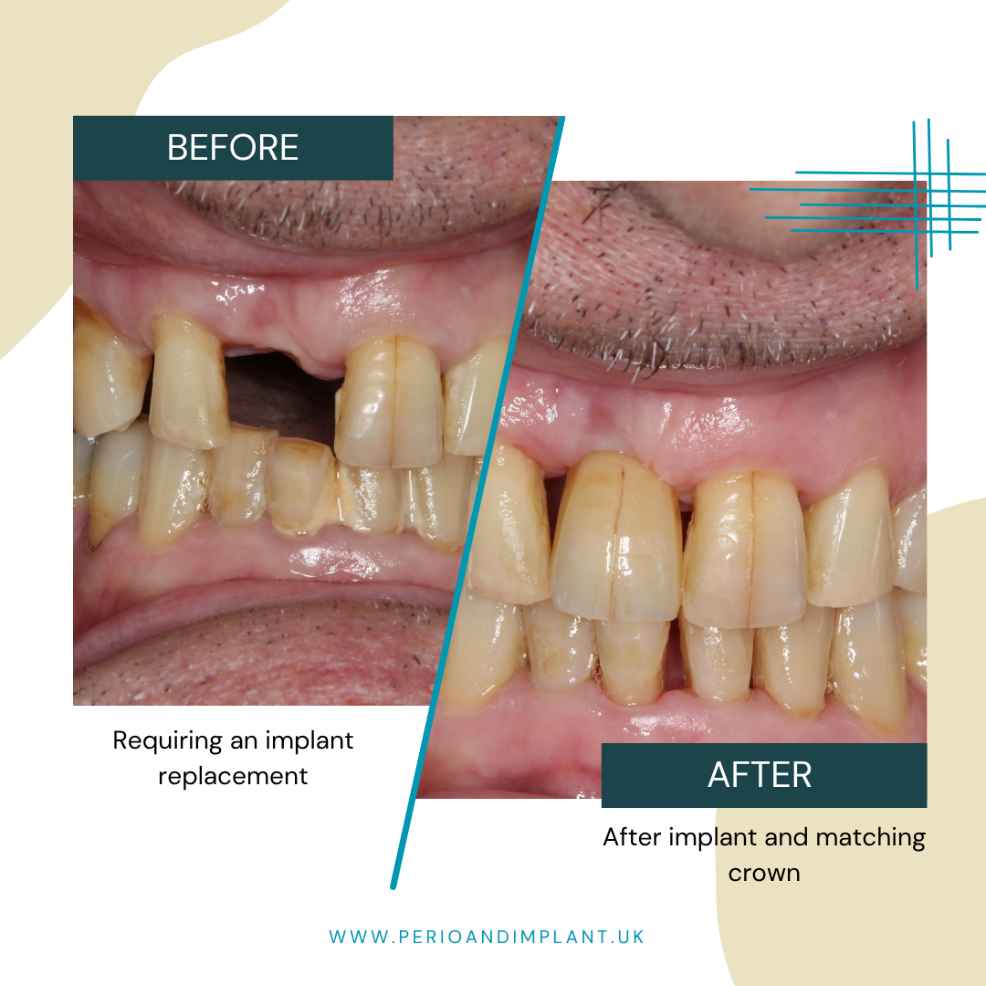 Before and after of a dental procedure