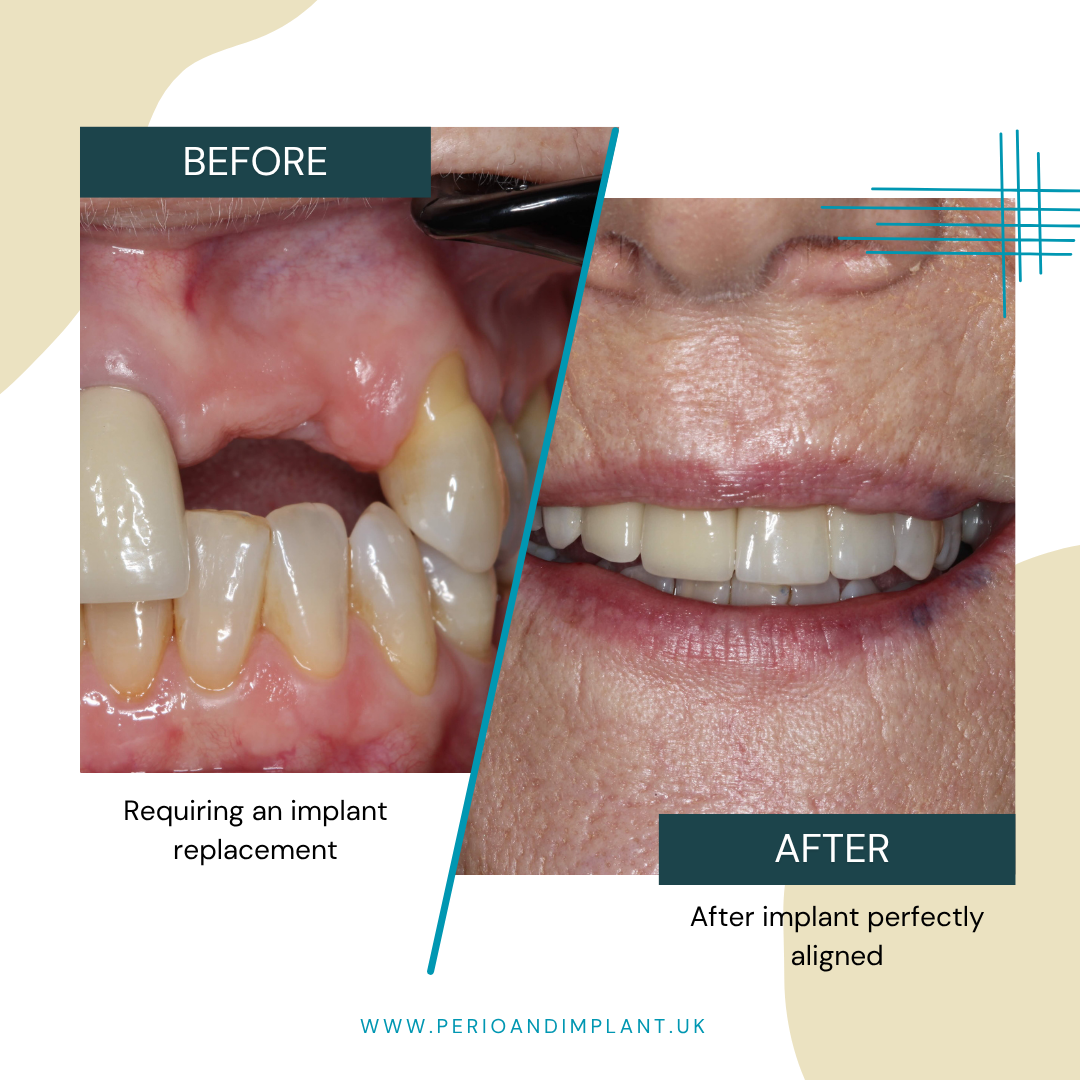 Before and after of a dental procedure