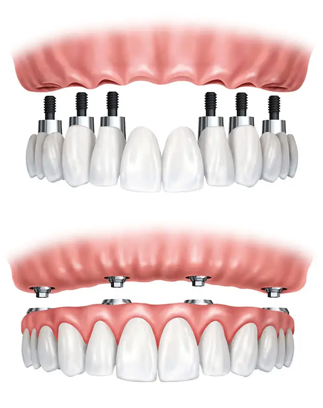 Full-Arch Rehabilitation