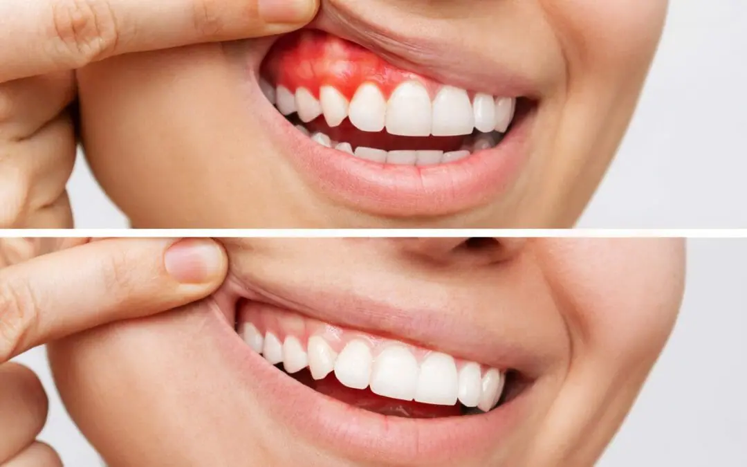 Comprehensive Gum Disease Management