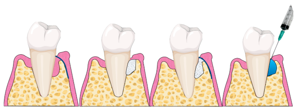 Regenerative Procedures