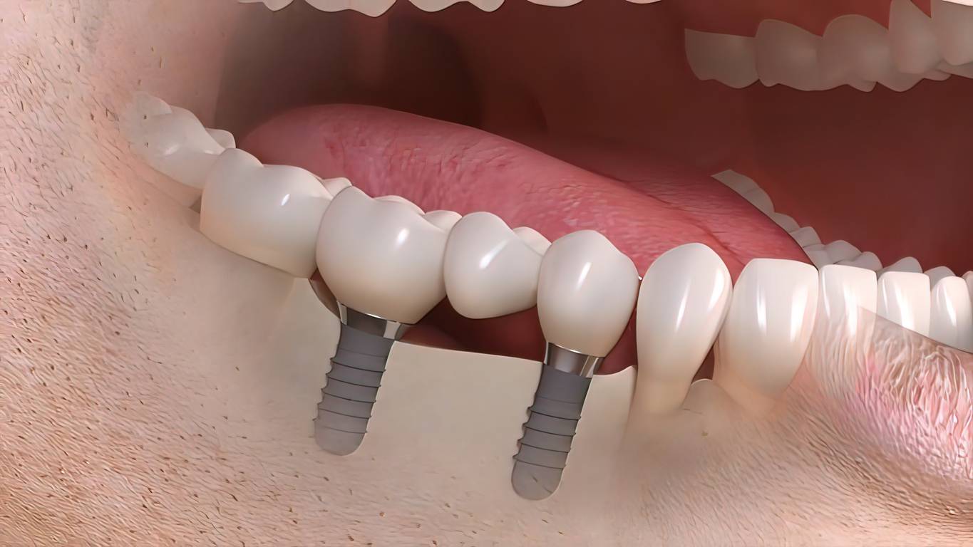 Single & Multiple Tooth Replacement